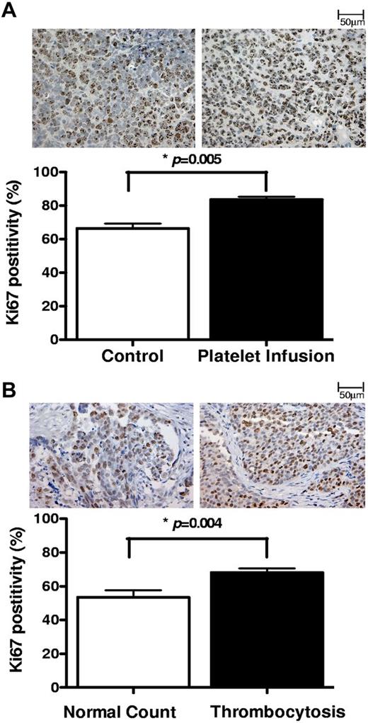 Figure 2. Proliferative effect of platelet on ovarian cancer cells in vivo. The proliferation index was measured in (A) tumors resected from tumor-bearing mice infused with buffer (control; n = 10) or platelets (n = 10) and (B) surgical specimens from ovarian cancer patients with normal platelet counts (n = 10) or thrombocytosis (n = 10), by Ki67 immunostaining. From each tissue block 5 sections were prepared, and from each section 5 fields were counted at original magnification ×200 of a light microscope by 2 different observers as independent blinded assessments. The ratio of positive Ki67 nuclear staining to total number of nuclei was measured for each field. The cumulative results are summarized as bar graphs, and a representative Ki67 staining is shown above each column.