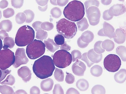 An 11-day-old boy presented with high-grade fever since the second day of life. He was dysmorphic with Down syndrome (DS) facies, pallor, irritability, tachypnea, pan-systolic murmur, and hepatosplenomegaly. Hemoglobin was 98 g/L, white cells were 254 × 109/L, and platelets were 31 × 109/L. Peripheral blood film (see figure) displayed 95% blast cells having deeply basophilic cytoplasm with blebs, multiple nucleoli, low platelets, and a few target cells. Liver enzymes and creatinine were normal. Circulating blasts were CD34+, CD36+, CD117+, CD13−, CD33−, and MPO−. Trisomy 21 was the sole cytogenetic abnormality. Supportive treatment was initiated. Leukapheresis and low-dose Ara-C were planned; however, the parents refused treatment and took the child out of the hospital. Transient myeloproliferative disorder (TMD) remained unresolved and the neonate soon succumbed to cardiorespiratory failure. / TMD was the presumed diagnosis because the child was a neonate with hepatomegaly and blasts with trisomy 21 with no other chromosomal abnormalities. TMD is a unique hematologic feature seen in 10% of neonates with DS. Its clinical, morphologic, and phenotypic features are indistinguishable from acute megakaryocytic leukemia (AMKL) but the blasts universally show trisomy 21 in TMD. Spontaneous remissions occur often but fatal forms are seen in 16% to 23% of cases.