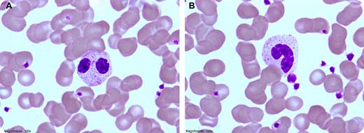 The peripheral smear of a 35-year-old man showed 47% bilobed neutrophils (panel A) and 45% band forms (panel B). A diagnosis of Pelger-Huet anomaly was considered. When a similar smear, seen earlier in a 3-year-old boy was remembered, it was learned that the patients were father and son. A diagnosis of congenital Pelger-Huet was affirmed. / Pelger-Huet anomaly is a rare autosomal dominant disorder characterized by pince-nez appearance of the nuclei of the neutrophils. This is caused by failure of nuclear segmentation due to genetic defect in the LBR (laminin B-receptor) on the chromosome 1q41-43. Heterozygotes have dumbbell-shaped or hyposegmented neutrophils with coarse chromatin and normal granules. Homozygotes have neutrophils with a single, round, eccentric nucleus with clumped chromatin and no nuclear segmentation. It is important to recognize Pelger-Huet anomaly as a benign condition. An acquired abnormality is referred to as pseudo Pelger-Huet anomaly. This may occur in myelodysplastic disorders, myeloproliferative diseases, and acute and chronic leukemias, reactions to drugs, and so on. The history and peripheral smear make the differential between congenital Pelger-Huet and acquired.
