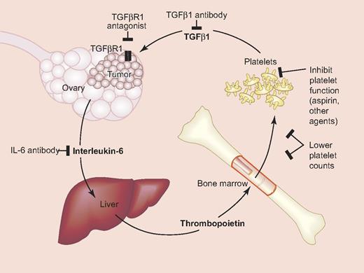Platelet-ovarian cancer signaling pathways and potential therapeutic targets. Interleukin-6 secreted by ovarian cancer cells stimulates hepatic thrombopoietin (TPO) production, which drives thrombopoiesis in the bone marrow and thrombocytosis. TGFβ secreted from platelets interacts with cancer cells to increase proliferation. Also shown are potential targets for modulating these interactions. Modified from Stone at al.7 Professional illustration by Paulette Dennis.