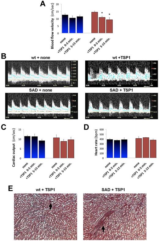 Figure 1. TSP1 triggers vaso-occlusive crises in SAD mice. We injected recombinant TSP1 (1 mg/kg) intravenously to wild-type (WT; blue) and SAD transgenic mice (brown) and characterized vaso-occlusions in kidneys by echo-Doppler recording of hemodynamic parameters. (A) We determined mean blood flow velocity (cm/s) in the right renal artery, before (none), or within 1 to 5 minutes, or between 5 and 20 minutes of TSP1 injection (*P < .05 vs control, none). (B) Representative echo-Doppler waveforms in the renal artery of WT and SAD mice before and after injection of TSP1. We also determined the heart rate (C; beats per minutes) and calculated the cardiac output (D; mL/min) from recording in the pulmonary artery. (E) Histologic analysis of wild-type and SAD kidneys 5 minutes after TSP1 injection by Masson trichrome. Black arrows show areas of vascular congestion and erythrocyte deposits.