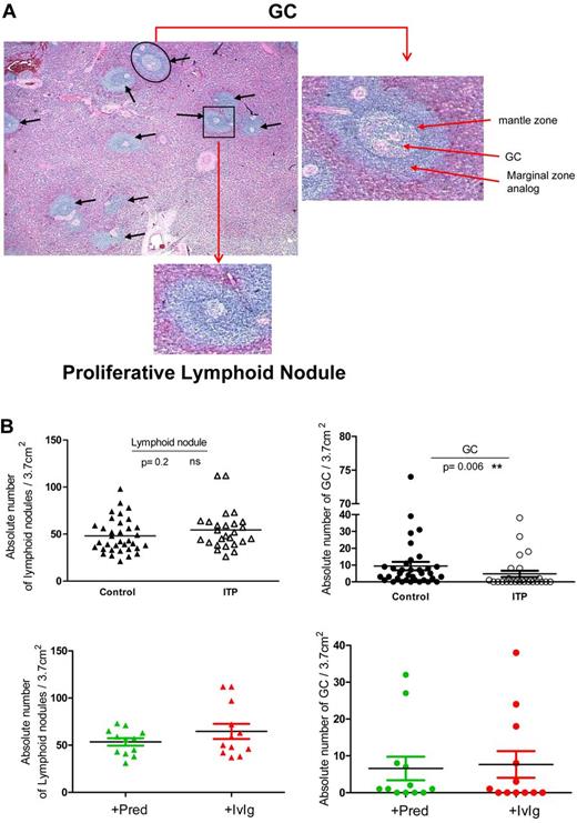 Figure 1. Microscopic quantification of GCs and other lymphoid nodules in human spleens. (A) Representative photomicrograph of an H&E-stained section of an ITP spleen with GCs within a lymphoid nodule identified as an aggregate of nonhomogeneously basophilic cells with distinct DZ and LZ (black circle). An enlargement of a characteristic GC is shown on the right. Black arrows indicate lymphoid nodules and the black square indicates a typical PLN within the white pulp. An enlargement of a characteristic PLN is shown underneath. (B) The number of GCs and lymphoid nodules was counted within spleen sections from 26 patients with ITP and 35 controls. ITP patients were grouped according to the underlying treatment before splenectomy as those treated with prednisone (+Pred) or with IvIg in combination with others medications (+IvIg). Each spleen section was normalized to 3.7 cm2 as described in “Quantification of GCs in spleen sections” and visualized with an Olympus BX70 microscope (×50 magnification).