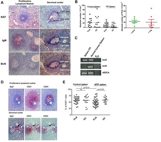 Figure 2. Characterization of PLNs in human spleen. (A) Representative photograph of Ki67 staining of spleens from 7 controls and 7 ITP patients showing GCs with LZ/DZ polarization and PLNs with a homogeneous distribution of proliferating cells. Representative photograph of IgM staining of spleens from 8 controls and 8 ITP patients showing GCs mostly lacking the expression of IgM and PLNs exhibiting the dense presence of IgM. Sections of 9 ITP and 10 control spleens were stained for expression of Bcl6, which was mostly limited to the DZ of the GCs and absent in PLNs. Visualization with a Zeiss Axio Imager Z1 fluorescence microscope (×200 magnification). The photomicrographs shown here are from ITP spleens. (B) GCs and PLNs were identified by either Ki67 or IgM stains and the total number of these structures/3.7 cm2 of spleen sections was determined by counting 9 spleen sections from ITP and 11 sections from control. Samples of ITP spleens were divided into those who had received prednisone (Pred) and those who received IvIg just before splenectomy and the number of PLN determined. (C) Comparison of the expression of bcl6, AIDCA, and bcl2 mRNA in spleen from ITP sections versus normal spleen. Distilled water (H2O) was used as a negative control of PCR. Representative RT-PCR of 8 sections from ITP spleen is shown. Each of these sections lacked identifiable GCs. (D) Serial sections of 10 ITP and 10 controls spleens were stained to evaluate the expression of Ki67, CD21, and CD23 in both PLNs (top panels) and GCs (bottom panels). The black arrows mark the dark zone (Ki67+, CD21+/−, and CD23−) and the white arrows indicate the light zone (Ki67+/−, CD21+, CD23+) of a GC. Visualization with Zeiss Axio Imager Z1 fluorescence microscope (×200 magnification). The photomicrographs shown here are from ITP spleens. (E) Comparison of the frequency of proliferating cells in splenic GC and PLN after staining with Ki67. Data are expressed as percentage of Ki67+ cells.