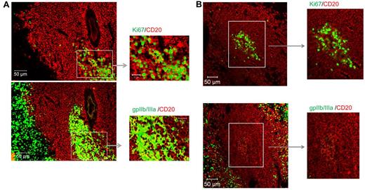 Figure 6. Detection of proliferating B cells and autoantigen within PLNs of ITP spleens. Sections from (A) 2 ITP spleens and (B) 1 control were stained for CD20 (red), Ki67 (green), or GPIIb/IIIa (green) and assessed for the presence of proliferating B cells and B cells in proximity to GPIIb/IIIa. Visualization was carried out with a Zeiss Axio Imager Z1 fluorescence microscope (×200 magnification).
