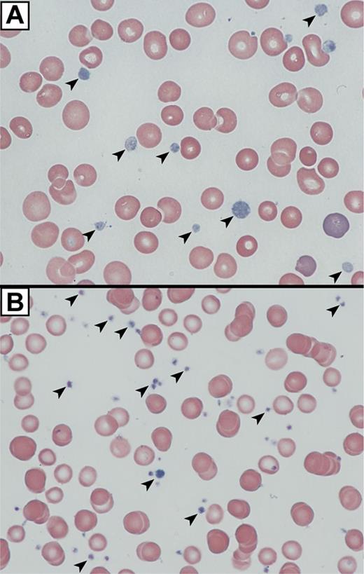 Figure 4. VPS16B null platelets appear abnormal in blood films. Romanowsky (Wright-Giemsa)–stained blood films from a VPS16B-deficient ARC patient compared with a neonatal control visualized using oil-immersion 63×/1.4 objective lenses. (A) VPS16B null platelets appeared large, homogeneous, pale and nongranular (arrows). (B) Normal neonatal control platelets are typically smaller, and granular (arrows).