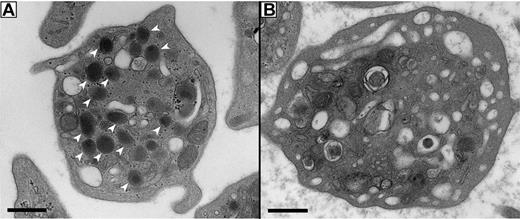 Figure 5. Absent α-granules in platelets from VPS16B null patients. Thin-section transmission electron micrographs of representative platelets from control neonatal and VPS16B null neonatal blood. Magnification is ×30 000 and scale bar represents 500 nm. (A) Control platelets contain multiple α-granules (white arrowheads), which are absent in VPS16B null platelets (B). The dark-staining structures seen in the VPS16B null platelet (B) contain distinct internal membranes that probably represent mitochondria.