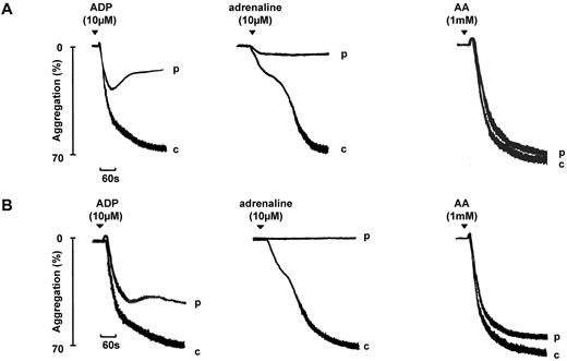 Figure 1. Aggregation to ADP and adrenaline in 2 participants diagnosed with a Gi-like defect. Aggregation in 2 participants (p) diagnosed with a Gi-like defect is shown. The participant in panel A shows a partial primary wave response to adrenaline, whereas for a second participant shown in panel B, the primary wave is absent. “c” indicates the control (healthy volunteer). Note that the biphasic aggregation to ADP shown in panel B would eventually decline. The patterns of aggregation are representative of other participants diagnosed with a Gi-like defect.