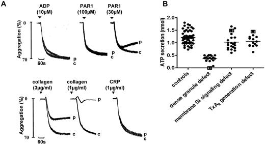 Figure 3. Aggregation and ATP secretion in a participant diagnosed with a dense granule defect. (A) Aggregation in a participant diagnosed with a defect in dense granule secretion on the basis of a significantly reduced level of secretion to high concentrations of PAR-1–specific peptide and other platelet agonists, including PAR-4–specific peptide and CRP relative to a panel of controls. “c” indicates control (healthy volunteer). The pattern of aggregation is representative of other participants diagnosed with a secretion disorder. (B) ATP secretion was measured alongside aggregation in a Born lumi-aggregometer in PRP using Chrono-Lume reagent for the detection of ATP. The degree of ATP secretion (after normalization to platelet count, supplemental Figure 2) to PAR-1–specific peptide (100μM) in healthy volunteers and participants diagnosed with defective dense granule secretion is shown. Participants identified with mutations in the P2Y12 (present study), TxA2 receptors,10 and HPS-819 are identified by square brackets.
