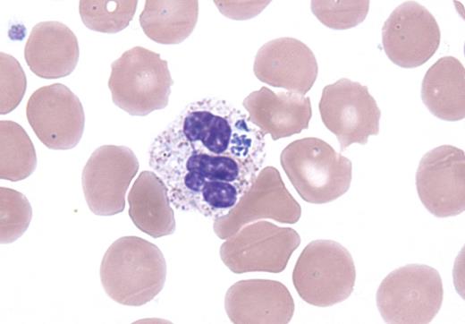 A 64-year-old man was admitted with hypotension and respiratory failure after 3 weeks of low-grade fever, cough, fatigue, intermittent sweats, chronic diarrhea, and headache. Seven years earlier he was the recipient of an unrelated bone marrow transplant for relapsed B lymphoblastic leukemia and was currently off immunosuppressive therapy. He resided in New England and was an avid hunter. His wife reported multiple tick exposures, most recently 1 week before the onset of symptoms. His white blood cell count was 19.27 × 109/L with 84% neutrophils and 14% bands, and the hemoglobin and platelets were normal. Most of the granulocytes contained intracytoplasmic inclusions (see figure). Transaminases, alkaline phosphatase, lactate dehydrogenase, and bilirubin were elevated. Creatinine was 2.09 mg/dL. PCR was positive for Anaplasma phagocytophilum. Tests for Lyme disease and babesiosis were negative. Despite broad-spectrum antibacterial therapy that included doxycycline, the patient's condition deteriorated and he died of Anaplasma sepsis 1 week later. / A phagocytophilum is the etiologic agent for human granulocytic anaplasmosis (HGA), a tick-borne illness that is endemic to New England with the highest incidence (36.5 cases per million) in Rhode Island. HGA typically presents as an acute illness with leukopenia, thrombocytopenia, and abnormal liver function tests. Thrombocytopenia is seen more frequently than leukopenia. Intracytoplasmic morulae are seen in neutrophils in 60% to 80% of cases.