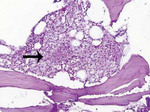 A 28-year-old black man was admitted to Presbyterian Hospital of Pittsburgh, PA, in August of 1959 with fever, hepatomegaly, and pulmonary infiltrates. Tuberculosis was suspected but the sputum examination was negative for acid fast bacilli. Needle biopsy of the posterior iliac crest (Westerman-Jensen needle) revealed granulomas (see figure) and the culture was positive for Mycobacterium tuberculosis. This prompted the initiation of isoniazid, steroids, and streptomycin. One week later a liver biopsy showed granulomas as well. After 5 weeks of therapy the patient had considerable improvement. A repeat bone marrow biopsy 7 weeks after the diagnosis showed no granulomas. / The biopsy in this patient was the first use of a needle biopsy for the diagnosis of systemic disease, a finding of historic and diagnostic importance. In the subsequent 53 years, the needle marrow biopsy has become routine for hematologists and oncologists to obtain additional information on systemic disorders such as metastatic neoplasms, staging of lymphomas, estimation of bone marrow cellularity, fibrosis, and iron stores, and for evaluation of metabolic bone diseases.