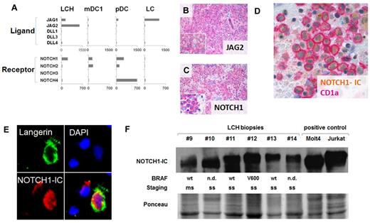 Figure 2. JAG2 and active NOTCH1 are detected in lesional LCH cells in situ. (A) LCH cells are the only DCs that coexpress Notch receptor and ligand. RMA normalized expression values for Notch-receptors and Notch-ligands. (B-D) Immunohistochemical analysis of paraffin-embedded LCH material. Sections were stained with Abs to JAG2 (B), full-length NOTCH1 (C), and activated NOTCH1 (D-E). Corresponding isotype controls are shown in supplemental Figure 5B. LCH samples LCH13 (B-C), LCH15 (D), and LCH16 (E) are shown. Immunofluorescence staining of a frozen LCH section showing staining for Langerin (green), DAPI (blue), and activated NOTCH1 (red). (F) Immunoblot analysis showing activated NOTCH1 in biopsy material from LCH patients. MOLT-4 and Jurkat cell lines were used as positive controls. Ponceau staining was used to ensure comparable loading.