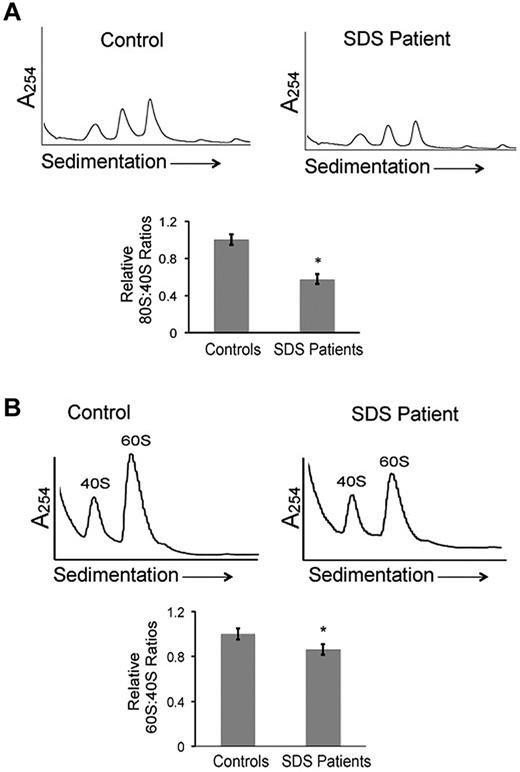 Figure 1. Ribosomal profiles are altered in SDS patient cells. (A) Bone marrow stromal cell lysates from healthy controls or SDS patients were fractionated through 7%-47% sucrose gradients by ultracentrifugation. Representative polysome profiles are shown. Relative 80S:40S ratios were quantified for 3 healthy controls versus 5 SDS patients (DF259, FHCRC18, FHCRC30, FHCRC32, UW1) of different SBDS genotypes (listed in supplemental Table 1). (B) Ribosomes were dissociated with 0.5M KCl or 0.25mM MgCl2 into 40S and 60S subunits, followed by sucrose density centrifugation. Representative polysome gradients are shown. 60S:40S ratios in 0.5M KCl were quantified for 3 healthy controls versus 3 SDS patients (DF259, FHCRC32, UW1) and the aggregate results are graphed; *P < .05. For 2 controls and 2 patients, the assay was repeated up to 3 times with consistent results (methods to quantitate the 40S, 60S, and 80S peaks are illustrated in supplemental Figure 1).