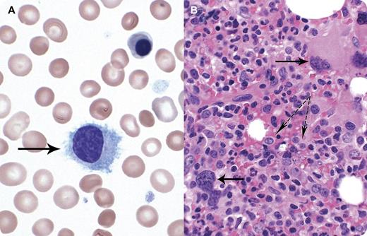 A 59-year-old female was diagnosed 13 years earlier with JAK2 617-positive polycythemia vera (PV) and treated with phlebotomies. Recently she developed progressive splenomegaly and decreased needs for phlebotomy. A diagnosis of post–PV-myelofibrosis was considered, but not confirmed initially by bone marrow (BM) examination. Laboratories tests showed hemoglobin, 92 g/L; platelet count, 119 × 109/L; white blood cell count, 8.6 × 109/L; and lymphocytes, 1.71 × 109/L. Peripheral blood film revealed medium-sized lymphoid cells with indented nucleus, blue cytoplasm, and circumferential projections (panel A solid arrow). BM showed hypercellularity, increased number of abnormally lobated megakaryocytes (panel B solid arrows), and diffuse infiltrates of lymphoid cells (panel B dotted arrows). Flow cytometry showed a λ light chain–restricted clonal B-cell population positive for CD19/20/FMC7/103 and bright CD11c, but negative for CD5/23/10/25/103. Molecular analysis was negative for BRAF V600E mutation. Findings were consistent with hairy cell leukemia variant. A rapid improvement in splenomegaly and cytopenias and disappearance of hairy cells in BM was observed after 1 course of cladribine. / There is increased recognition that patients with myeloproliferative neoplasm (MPN) are at higher risk of lymphoproliferative neoplasms. Physicians should be aware of such association. Even in a patient with typical history suggesting MPN, a peripheral blood smear review should be performed with additional investigations, as needed.
