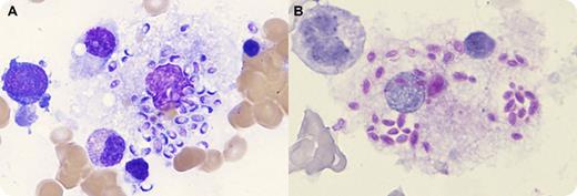 A 44-year-old newly diagnosed HIV-positive man with CD4 count of 47 × 10−6/L (410-1545 × 10−6/L) was admitted to intensive care for management of acute renal failure, profound hypoglycemia, and hemodynamic instability in the setting of pentamidine treatment for Pneumocystis jirovecii pneumonia. A bone marrow biopsy was performed to investigate progressive pancytopenia (hemoglobin 65 g/L, neutrophils 0.41 × 109/L, and platelets 23 × 109/L). Inspection of the bone marrow aspirate revealed innumerable oval/crescent-shaped yeast cells in both intracellular and extracellular distribution, most prominently seen within marrow histiocytes (panel A). Periodic acid-Schiff positively stained the organisms (panel B). Comparison to the published literature and online images yielded a working differential diagnosis of histoplasmosis (Histoplasma capsulatum) or Penicillium marneffei infection. Images of the marrow were referred for expert review and deemed to be most consistent with histoplasmosis. Histoplasma capsulatum was confirmed from fungal culture of the marrow aspirate and PCR for fungal ribosomal RNA. The patient was treated with amphotericin and itraconazole and made a full recovery. / Histoplasma capsulatum and Penicillium marneffei are opportunistic fungi occasionally disseminated in AIDS patients. While an experienced microbiologist may differentiate the 2 infections with microscopy and the time to culture differs, molecular studies are required for definitive diagnosis.