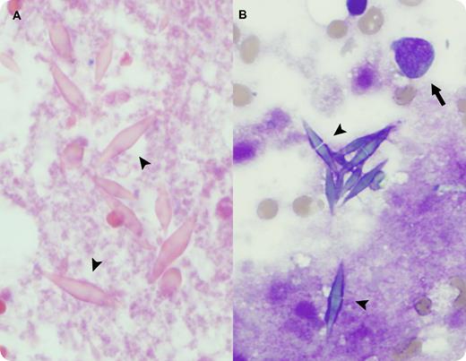 A 70-year-old woman with renovascular hypertension presented with 8 weeks of worsening chest pain, back and leg pain, dyspnea, and fatigue. She had a faint petechial rash on the abdomen and thighs. Complete blood count showed leukocytosis (26.6 × 109/L), anemia (100 g/L), and thrombocytopenia (114 × 109/L). Manual differential count revealed 5% myeloblasts, 2% myelocytes, 1% metamyelocytes, < 1% eosinophils, and a reticulocyte count of 1.6%. Red cell morphology was unremarkable except for polychromasia. / Bone marrow core biopsy revealed numerous bipyramidal Charcot-Leyden crystals (CLCs) (panel A arrowheads) within extensive bone marrow necrosis, precluding definitive diagnosis. Repeat bone marrow aspiration showed CLCs (panel B arrowheads) and 36% myeloblasts (panel B arrow), diagnostic of acute myeloid leukemia. Eosinophils and precursors were not prominent. Despite aggressive management, the patient died of complications before initiation of chemotherapy. / CLCs are composed of a lysophospholipase normally found in eosinophils and may be seen in inflammatory conditions or hematologic malignancies with eosinophilia. CLCs in acute myeloid leukemia are rare and may be accompanied by extensive bone marrow necrosis, as seen in this case. Notably, morphologic evidence of increased eosinophils may or may not be present. The source of lysophospholipase and CLCs in cases lacking eosinophilia is unknown.