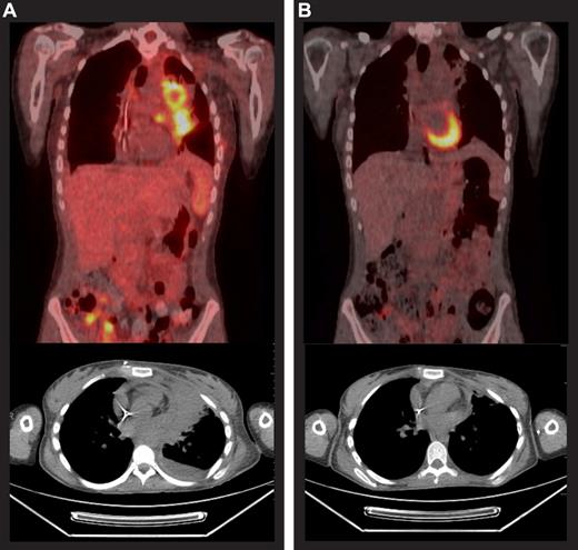 Figure 3. Case study before and after brentuximab vedotin therapy. Positron emission tomography scans before (A) and after (B) 9 cycles of brentuximab vedotin for a 20-year-old patient who had been diagnosed with HL 3 years earlier. The patient had received 4 cycles of doxorubicin, bleomycin, vincristine, etoposide, prednisone, and cyclophosphamide followed by external beam radiation that yielded a CR lasting 2 months. She was next treated with 2 cycles of ICE, achieving a PR lasting 1 month. Subsequently, gemcitabine, vinorelbine, and doxorubicin (GND), followed by BEAM autoSCT yielded a PR lasting 3 months. She underwent alloSCT for relapsed disease, conditioned with busulfan, fludarabine, and total body irradiation (200 cGy) and had a matched, unrelated donor, but experienced disease progression 4 months after alloSCT. She received her first dose of brentuximab vedotin in December 2009, achieved a PR before the third dose, and a CR was reported after the ninth dose. She completed 16 treatment cycles and remained in CR at the last contact, 6 months after the last dose of brentuximab vedotin.
