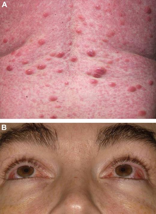Figure 1. Clinical features of T-PLL. (A) Nodular skin infiltration. (B) Periorbital and conjunctival edema.