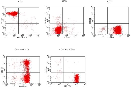 Figure 3. Flow cytometry in T-PLL showing negative membrane expression of CD3, strong expression of CD7 and CD5, and coexpression of CD4 and CD8. Courtesy of Ricardo Morilla (Royal Marsden Hospital).