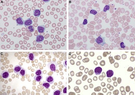 Figure 7. PB morphology of 4 different B-cell leukemias. (A) B-PLL, showing monomorphic prolymphocytes (PL) with condensed chromatin, prominent nucleolus, and scanty basophilic cytoplasm. (B) CLL/PL showing a single prolymphocyte (PL), and several typical CLL cells, which are half the size of the PL, have less cytoplasm and no nucleolus. (C) HCL-V showing cells with condensed chromatin and a conspicuous single nucleolus, but with more abundant pale cytoplasm with cytoplasmic projections. (D) SMZL showing lymphocytes with short polar villi and basophilic cytoplasm.