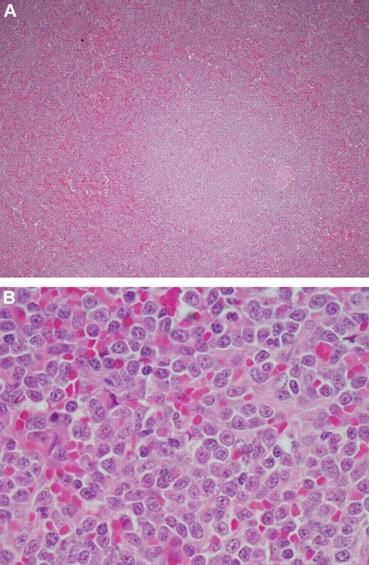 Figure 8. Histology of the spleen in B-PLL. (A) Low power view (original magnification ×20) showing replacement of the white pulp and infiltration of the red pulp. (B) High power view (original magnification ×100) of the white pulp showing the typical prolymphocyte morphology with abundant cytoplasm, round nuclei, and a central eosinophilic nucleolus. Courtesy of Andrew Wotherspoon (Royal Marsden Hospital)
