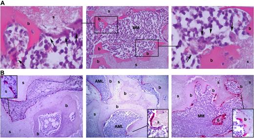 Figure 3. Engraftment of pMM cells in humanized mice coincides with osteolysis. (A) H&E staining shows an irregular bone surface with osteoclast-like cells (arrows). Shown is a representative slide (middle panel) of an MM-infiltrated ossicle (s) covered with bone (b). The left and right panels show the boxed areas at higher magnification. (B) Analysis of control (left panel)–, pAML (middle panel)–, and pMM (right panel)–engrafted ossicles for the presence of osteoclasts by tartrate-resistant acidic phosphatase staining. Shown are representative slides of a control, pMM-, and pAML-engrafted ossicle stained for tartrate-resistant acidic phosphatase.