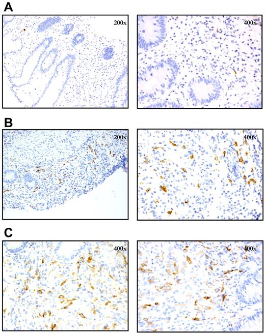 Figure 5. Expression of CD30 in diagnostic intestinal biopsy specimens as assessed by immunohistochemistry. (A) Patient without aGVHD who was diagnosed with C difficile colitis; CD30+ cells are rare (mean 0.4 per 400× field). (B) Patient with clinical grade 2 intestinal aGVHD, with numerous CD30+ cells (mean 4.7 per 400× field). (C) Patient with clinical grade 4 intestinal aGVHD, with numerous CD30+ cells (mean 3.5 per 400× field).