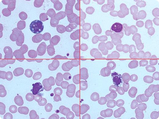 A 26-year-old woman had a 4-day history of fever, aches, and throat irritation. She had tender right posterior cervical lymphadenopathy and mild hepatosplenomegaly. Her hemoglobin was 12.6 g/dL, white blood count 5.5 × 109/L with relative lymphocytosis (58%), and platelet count 100 × 109/L. The peripheral smear showed reactive lymphocytes with rare (1%) apoptotic lymphocytes (top left panel shows apoptosis with nuclear condensation and bleb; top right, with nuclear condensation only; bottom left, with bleb formation; and bottom right, with nuclear fragmentation). Liver function tests were moderately abnormal. Malarial parasite, dengue, blood culture, viral hepatitis markers, and Widal were negative. The frequency of apoptotic lymphocytes increased to approximately 10% by the fifth day. Infectious mononucleosis was considered, but a monospot test was negative. The patient was treated symptomatically. The fever persisted, and a repeat peripheral smear still showed reactive lymphocytes with occasional apoptosis. A test for EBV IgM was positive (30U/mL, range: < 8), confirming the diagnosis of infectious mononucleosis. / Apoptosis of lymphocytes may appear as cell shrinkage, nuclear pyknosis and fragmentation, and nuclear blebs. When present, these changes can be seen in lymphoid malignancies, with chemotherapy, diabetes mellitus, connective tissue diseases, and HIV. In an appropriate clinical setting, apoptosis along with reactive lymphocytes is a strong clue for viral infection, such as infectious mononucleosis.