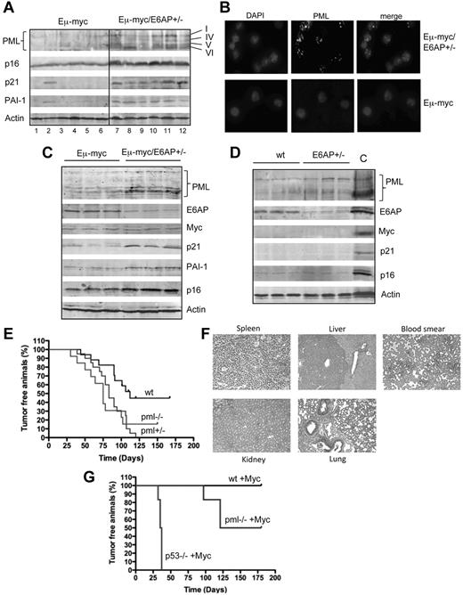 Figure 6. The critical role for PML in suppression of Myc-driven lymphomas: elevation of PML and PML-NB in lymphoma cells and premalignant B-lymphoid cells from Eμ-myc/E6AP+/− mice. (A) Immunoblot analysis of the indicated proteins in extracts from Eμ-myc/E6AP+/− and control (E6AP+/+) Eμ-myc lymphomas. Probing for actin was used as a loading control. PML isoforms are indicated. (B) Immunofluorescence staining of PML nuclear bodies in lymphomas from Eμ-myc/E6AP+/− and control (E6AP+/+) Eμ-myc mice. Magnification ×1000. (C) Immunoblot analyses of the indicated proteins in premalignant B-lymphoid cells from 4-week-old Eμ-myc/E6AP+/− and control (E6AP+/+) Eμ-myc mice. Probing for actin was used as a loading control. (D) Immunoblot analyses of the indicated proteins in B lymphoid cells from 4-week-old E6AP+/− and control WT (E6AP+/+) mice. Probing for actin was used as a loading control. Lymphoma extract (A, lane 11) was used as a positive control (C). (E) PML loss accelerates tumor onset in Myc-expressing tumors. Eμ-myc transgenic mice were crossed to PML−/− mice. The resulting Eμ-myc mice that were either WT, Pml+/−, or Pml−/− were monitored for tumor onset by spleen as well as lymph node palpation and weekly blood smear analysis. The onset of lymphomas in both Eμ-myc/Pml +/− and Eμ–myc/Pml −/− mice was substantially accelerated compared with control Eμ-myc mice (P < .01). (F) Staining of tissue sections with hematoxylin and eosin revealed that Eμ-myc/Pml−/− lymphomas were highly invasive and infiltrated into the liver, but not kindey or lung. Magnification ×200. (G). HSCs derived from fetal livers of WT, p53−/−, and Pml−/− mice were retrovirally transduced with a MSCV-Myc construct coexpressing green fluorescent protein. The genetically modified stem cells were then used to reconstitute the hematopoietic system of lethally irradiated recipient (WT) animals, which were monitored for lymphoma onset by palpation, weekly blood smears, and whole body fluorescence imaging. Recipients of WT stem cells transduced with the Myc expression did not develop tumors over the observation period, whereas all of the recipients of Myc expression construct transduced p53−/− HSC developed very aggressive disease in a short time. Recipients of Myc expression construct transduced Pml−/− HSCs developed lymphoma more rapidly compared with the mice transplanted with the Myc expression construct transduced WT HSCs (P < .0003), again suggesting that PML can suppress Myc driven lymphoma development.