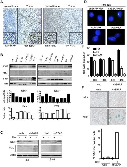 Figure 7. E6AP levels are elevated in human Burkitt lymphomas and down-regulation of E6AP restores PML-induced cellular senescence. (A) Representative images of E6AP (left panel) and PML (right panel) immunostaining in human Burkitt lymphomas. Expression of E6AP is relatively low in normal lymphoid tissue, but the infiltrating Burkitt lymphoma cells show elevated levels of E6AP accompanied by reduced levels of PML; N = 20; Magnification ×200. (B) Immunoblot analysis to determine the levels of E6AP, PML, and c-Myc in a panel of cell lines derived from Burkitt lymphoma derived (J-1, LOUCIF, LY-67, BL-2, MC116, LS-92, LOUCIF-BL, JOY-BL), DLBCL (SUDHL-4, FARAGE, TOLEDO, DB, HT), or follicular lymphoma (DOHH2). Probing for actin was used as a loading control. The expression levels of E6AP and PML normalized against the levels of actin were quantified and are presented on the graphs (bottom panel). (C) Immunoblot analysis of the indicated proteins in J-1 and LS-92 Burkitt lymphoma derived cells transduced with inducible lentiviral constructs containing wobble E6AP or shRNA for E6AP that were treated with (+) or without (−) doxycyclin. Cells were analyzed 7 days after doxycyclin (dox) induction. Probing for actin was used as a loading control. (D) Immunofluorescence staining of PML-NBs in J-1 Burkitt lymphoma cells transduced with the aforementioned shRNA expression constructs on day 7 after dox treatment. Magnification ×1000. (E) Cell-cycle analyses of J-1 Burkitt lymphoma cells transduced with the aforementioned shRNA expression constructs on performed on day 7 after dox induction; *P < .001. Values represent means ± SD. (F) SA-β-gal levels were determined in cytospins of J-1 Burkitt lymphoma cells transduced with the aforementioned shRNA expression constructs on day 7 after dox treatment. Magnification ×400. Quantification of SA-β-gal positive cells: > 400 cells/cytospin, n = 3, cells were counted in 4 randomly selected fields. Values represent means ± SD, and were derived from 3 independent experiments performed in triplicate.