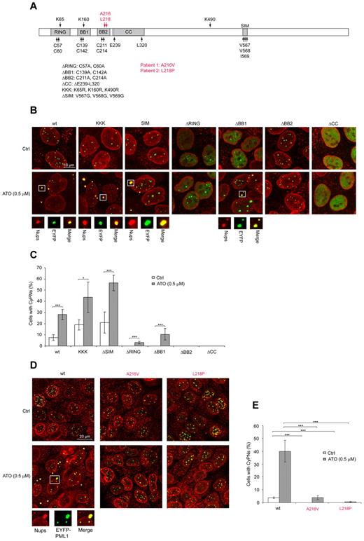Figure 4. SUMOylation is dispensable whereas the BB2 motif and amino acids mutated in ATO-resistant APL patients are required for effective CyPN accumulation. (A) Schematic overview of PML structural organization and mutations used in this study. Mutations identified in PML/RARA transcripts isolated from ATO-resistant APL patients are shown in red. (B) IF showing nucleoporins (red) together with WT or mutated EYFP-PML1 (green) stably expressed in HaCaT/shPML cells. Representative images of untreated cells and cells treated with 0.5μM ATO are shown. Images are projections of 5 to 6 confocal z-scans. Scale bar, 10 μm. (C) Quantification of CyPNs regenerated by WT or mutated EYFP-PML1 in HaCaT/shPML cells incubated in the presence or absence of 0.5μM ATO for 24 hours. For each sample more than 80 cells were analyzed. Data represent average of 3 independent experiments ± SD (*P < .05, ***P < .001). (D) IF showing nucleoporins (red) together with WT EYFP-PML1 or EYFP-PML1 containing the patient derived mutations A216V and L218P (green) stably expressed in HaCaT/shPML cells. Representative images showing untreated cells or cells treated with 0.5μM ATO are shown. Images display projections of 5 to 6 confocal z-scans. Scale bar, 20 μm. (E) Quantification of CyPNs regenerated by WT or mutated EYFP-PML1 in HaCaT/shPML cells incubated in the presence or absence of 0.5μM ATO for 24 hours. For each sample more than 100 cells were analyzed. Data represent average of 3 independent experiments ± SD (***P < .001).