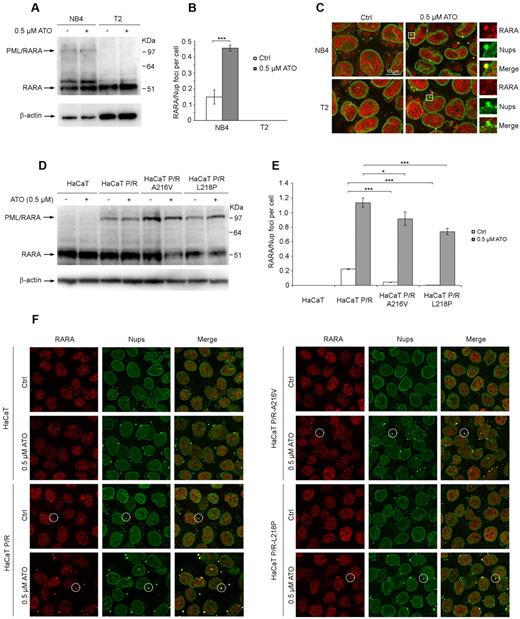 Figure 5. ATO stimulates increased accumulation of PML/RARA within CyPNs. (A) Western blot showing total RARA and PML/RARA expression in NB4 and T2 cells treated with or without 0.5μM ATO for 24 hours. Blots were probed using an anti-RARA antibody. β-actin was used as loading control. (B) Quantification of RARA-positive CyPNs in NB4 and T2 cells treated with or without 0.5μM ATO for 24 hours. For each sample more than 500 cells were analyzed. Data represent average of 3 independent experiments ± SD (***P < .001). (C) IF showing the localization of RARA (red) and nucleoporins (Nups; green) in NB4 and T2 cells treated with or without 0.5μM ATO for 24 hours. RARA-positive CyPNs are detected in NB4 cells, but not in T2 cells. Images represent projections of 5 to 6 confocal z-scans. Scale bar, 10 μm. (D) Western blot showing stable expression of WT and mutated (A216V and L218P) PML/RARA in HaCaT cells. Cells were treated with or without 0.5μM ATO for 24 hours and subsequently lysed in a urea-based extraction buffer. Blots were probed using an anti-RARA antibody. β-actin was used as loading control. (E) Quantitation of CyPNs in HaCaT cells stably expressing WT or mutated PML/RARA and treated with or without 0.5μM ATO for 24 hours. For each sample more than 100 cells were analyzed. Data represent average of 3 independent experiments ± SD (*P < .05, ***P < .001). (F) IF showing RARA (red) and nucleoporins (Nups; green) in HaCaT and HaCaT cells expressing WT or mutated PML/RARA (P/R). Selected foci containing Nups and RARA are highlighted. Scale bar, 20 μm.