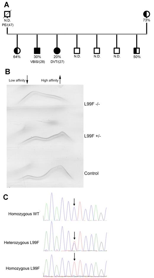 Figure 1. Characterization of the homozygous Budapest-III patients. (A) Pedigree of the thrombophilic family. Filled symbols indicate homozygous carriers, and half-filled symbols indicate heterozygous carriers. Anti-FXa activity values and the age of the first thrombotic episode (in brackets) are also indicated. N.D. indicates those cases where anti-FXa activity was unknown. N.D. indicates nondetermined; PE, pulmonary embolism; VBIS, vertebral-basilar ischemic stroke; and DVT, deep venous thrombosis. (B) Crossed immunoelectrophoresis in the presence of unfractionated heparin of the plasma of homozygous and heterozygous Budapest-III patients and control plasma. The antithrombin forms of high and low heparin affinity are indicated. (C) Electropherogram of the PCR-amplified product of exon 2 in a control, a heterozygous patient, and a homozygous patient for the L99F mutation. ↓ indicates the position of the mutation.