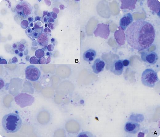 A 34-year-old male with a history of T cell–rich B-cell lymphoma relapsed 1 year after high-dose therapy with recurrent fevers, abdominal pain, and jaundice. He was cachetic with hepatosplenomegaly and ascites. Laboratory findings showed a white blood cell count of 2.7 × 109/L, hemoglobin 8.7 g/dL, platelets of 21 × 109/L, hyperbilirubinemia, and no evidence of hemolysis including a negative Coombs test. Bone marrow examination revealed marked hypercellularity and affirmed recurrent lymphoma (occupying 30%-40% of marrow). In addition, there was dysplasia of red cell precursors (panel A) and phagocytosis of bone marrow elements by lymphohistiocytes (panel B). A diagnosis of hemophagocytic lymphohistiocytosis (HLH) was made. Laboratory data consistent with HLH included albumin of 1.7 gm/dL, fibrinogen 65 mg/dL, ferritin > 15 000 ng/mL, and soluble IL-2 receptor > 6500 units/mL. The relapsed lymphoma was successfully treated with salvage therapy. A repeat bone marrow examination showed no lymphoma, normal hematopoiesis, an absence of dysplasia, and no phagocytosis. Several months later the patient relapsed and died. / HLH can be familial or associated with viral infections, autoimmune disorders, and some malignancies. Treatment of the underlying disorder may reverse HLH, as was true in this case. The appearance of HLH with lymphoma is rare and often associated with a poor outcome.