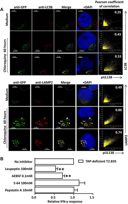 Figure 4. Subcellular localization of pUL138-eGFP and the effect of protease inhibitors. (A) Subcellular localization of pUL138-eGFP with LC3 and LAMP2 in T2.B35 stable transfectants. T2.B35 cells stably expressing pUL138-eGFP fusion protein were costained with anti-GFP in AlexaFluor-488 and anti-LC3B or anti-LAMP2 in AlexaFluor-546. Cells were either untreated or pretreated with chloroquine (80μM) for 60 hours. Colocalization of pUL138-eGFP (shown in green) and LC3 or LAMP2 (shown in red) is indicated in white. Blue represents nuclei staining with 4,6-diamidino-2-phenylindole (DAPI). Scale bars represent 5 μm. Original magnification ×64 (Olympus IX70 microscope, DeltaVision microscopy system). Image deconvolution and colocalization analysis performed with softWoRx. Right panels: scatter plots and degree of colocalization of pUL138-eGFP with LC3 or LAMP2 by Pearson coefficient of correlation. Results are representative samples from 3 independent experiments. (B) Effect of protease inhibitors on pUL138 TAP-independent antigen presentation. T2.B35 cells were pretreated with protease inhibitors and infected with AdUL138. Data shown are from 3 independent experiments performed in triplicate samples (mean ± SEM). **P < .05 (2-tailed Student t test). The mean absolute percentage of T-cell response to reference cells was 11.3%.