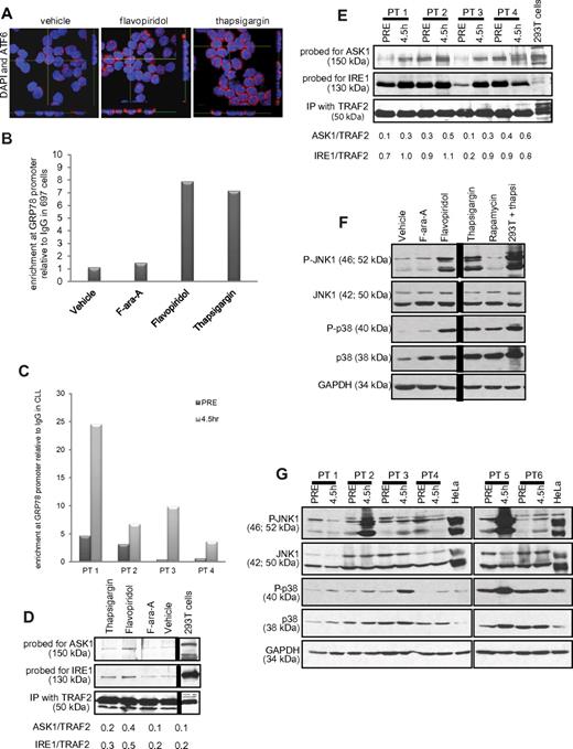 Figure 6. ER stress in CLL cells. (A) Confocal fluorescence microscopy for ATF6. Z stacks were collected (0.4 μm per slice), and images were chosen from the middle of nuclei. Side views (across bottom and side of figures) are also shown to depict ATF6 nuclear localization in CLL cells treated with flavopiridol (2μM) or thapsigargin (1μM) for 4 hours. Results shown are representative of 4 experiments. (B) ChIP assay data showing enrichment of ATF6 at the GRP78 promoter region with flavopiridol and thapsigargin treatment in 697 cells. Values of enrichment at promoter are presented relative to the IgG negative control. (C) ChIP assay data showing enrichment of ATF6 at GRP78 promoter region in cells from CLL patients undergoing flavopiridol treatment, collected before or at the end of flavopiridol infusion (4.5 hours). (D-E) Coimmunoprecipitation assay for IRE1-ASK1-TRAF2 complex formation 697 cells (D) or samples from flavopiridol-treated CLL patients (E) were immunoprecipitated with TRAF2 and immunoblotted for ASK1 or IRE1. (F) Immunoblots for total and phosphorylated JNK1 and p38MAPK in CLL cells treated in vitro with flavopiridol (2μM), thapsigargin (1μM), F-ara-A (5μM), and rapamycin (5μM). Results shown are from one representative patient sample. (G) Immunoblots for total and phosphorylated JNK1 and p38MAPK in samples from 6 CLL patients treated with flavopiridol; samples were collected before treatment and at 4.5 hours into flavopiridol infusion.