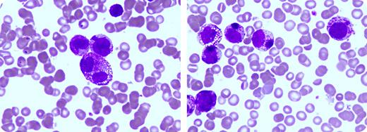 A 61-year-old male was evaluated for 3 months of abdominal pain, weight loss, and low-grade fever. He had pallor and hepatosplenomegaly. A complete blood count showed hemoglobin of 9.8 g/dL, white blood cell count of 6.9 × 109/L, and platelet count of 4.0 × 109/L. The peripheral blood smear revealed anisocytosis, polychromasia, nucleated red blood cells, early myeloid cells, and marked thrombocytopenia. Bone marrow aspirate showed diffuse infiltration with pleomorphic mononuclear cells forming clusters. These cells were large, some binucleated (left panel) with prominent granulation, noticeable vacuolization, and a rare, large, basophilic inclusion (right panel). These cells were negative with Sudan black B and periodic acid Schiff. Immunotyping was positive for leukocyte common antigen and CD30 and negative for CD3, CD20, Tdt, CD34, CD68, CKAE1/AE3, CD117, and PAX5. The anaplastic lymphoma kinase (ALK) protein was negative. / A diagnosis of anaplastic large cell lymphoma (ALCL), ALK negative was made. ALCL is an infrequent, aggressive T-cell lymphoma. Until recently it was considered a single disease with few distinctions between cases that were ALK positive and negative. Currently, ALK negative disease is recognized as a separate entity associated with morphologic differences, decreased response rates to therapy, and a poorer prognosis compared with ALCL, ALK positive tumors.