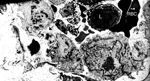 Figure 1. Gaps are present between endothelial cells in the synovium vasculature from patients with RA. Synovium from RA patients was scrutinized by electron microscopy. Black arrows indicate one gap between endothelial cells. E indicates endothelial cells; PL, platelets; L, lymphocytes; and RBC, red blood cells. Original magnification ×48 400.