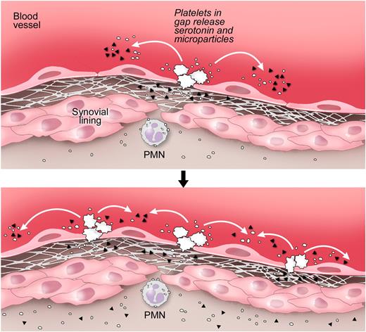 Figure 7. Proposed pathway for the formation of gaps and amplification of the vasculature permeability by platelets during arthritis. Top panel: Gaps between endothelial cells in arthritic joints are formed. The GPVI-expressing platelets are activated by the newly exposed subendothelial matrix rich in GPVI ligands, such as collagen and laminin. Bottom panel: Stimulated platelets produce copious amounts of IL-1–rich microparticles and release serotonin. Platelet-derived serotonin promotes the production of additional gaps; thus, more platelets can be activated. Serotonin at the site of inflammation promotes the vasculature leakage during disease. Note that the precise anatomic location of platelet activation and the route by which microparticles enter the joint remain speculative. ▴ represents serotonin; and ○, platelet microparticle. Illustration courtesy of Steve Moskowitz, Advanced Medical Graphics.