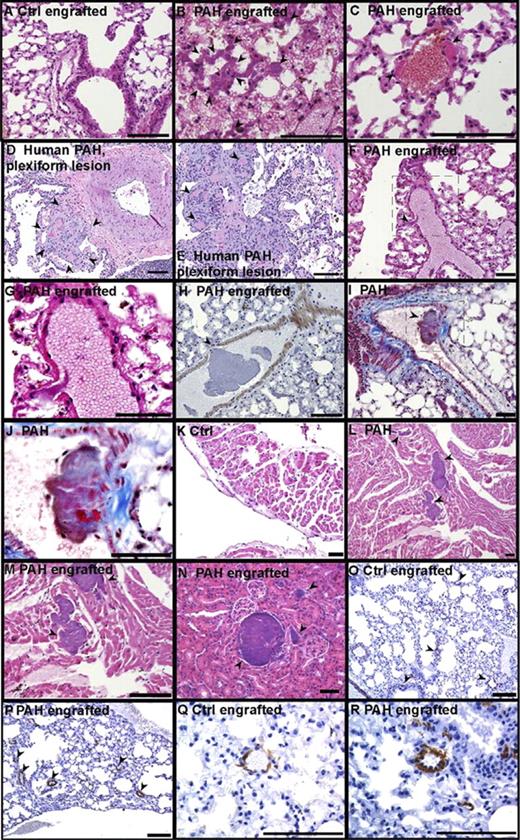 Figure 2. Vascular remodeling induced by CD133+ cells. Organs were harvested from CD133+-engrafted mice and fixed in formalin. A pathologist blinded to study groups analyzed paraffin-embedded tissue sections after specific stainings. (A) H&E staining of lungs from a control CD133+-engrafted mouse. (B-C) H&E staining of lungs from a PAH CD133+-engrafted mouse (B); arrows indicate in situ thrombi and recent thrombi (C). (D-E) Human PAH lung. Low- and high-power images of occlusion of tufts of capillaries in plexiform lesion by recent thrombi (arrows). (F-H) Lung endothelial cell damage in PAH CD133+-engrafted mice, H&E and α smooth muscle staining, respectively. (G) High-power field of the boxed region in panel D. (I-J) Lung PAH CD133+-engrafted mouse, organized thrombus in large vessel with recanalization (Masson trichrome). (J) High power of the boxed region in panel I. (K) H&E staining of heart from control CD133+-engrafted mouse. (L-M) H&E staining of heart from PAH CD133+-engrafted mouse, thrombi in the right ventricle with infarction and ischemia. (N) H&E staining of kidney from PAH CD133+-engrafted mouse. Arrows indicate in situ thrombi. (O-R) Lung α smooth muscle actin staining, blood vessels with muscle indicated by arrows. Scale bars indicate 100 μm.