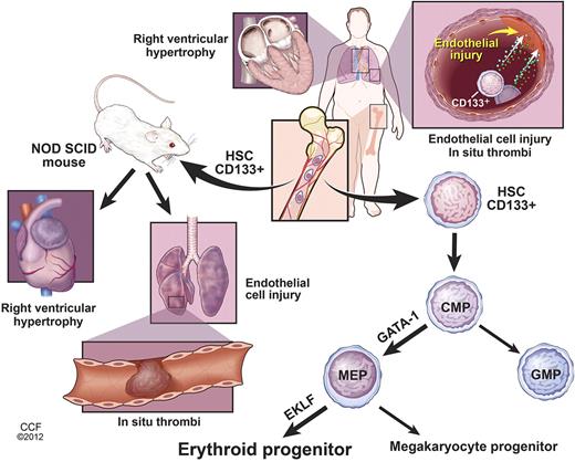 Figure 4. Right ventricular hypertrophy, lung endothelial cell injury, and in situ thrombi are common pathologic characteristics of patients with PAH. Increased numbers of BM-derived CD133+ stem cells are found in PAH pulmonary artery wall, but the lineage differentiation of these cells and whether they contribute to the vascular remodeling or play a reparative role are unknown. Increased expression of the myeloid transcription factor GATA-1 is found in PAH CD133+ hematopoietic stem cells (HSC) and common myeloid progenitors (CMP), which skew differentiation of PAH CD133+ cells into megakaryocyte-erythroid progenitors (MEP). Subsequently, EKLF expression in MEPs induces erythroid commitment, resulting in higher numbers of myeloerythroid progenitors in PAH BM. Engraftment of PAH CD133+ HSCs into NOD-SCID mice confirms the increased myeloerythroid proliferation. In analogy to human PAH, xenografted mice develop lung endothelial cell injury, in situ thrombi, and right ventricular hypertrophy. The data reveal a contributory role of BM CD133+ myeloid-erythroid progenitors in PAH. Illustration is reprinted with permission of the Cleveland Clinic Center for Medical Art & Photography (copyright 2012; all rights reserved).