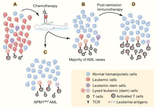 In full-blown AML (A), the T cells directed against the leukemia antigens cannot bring about enough lysis of leukemic (stem) cells to bring the disease under control. This is due to the fast dynamics and immunosuppressive mechanisms of AML. Chemotherapy strongly suppresses the leukemic cells and usually allows normal hematopoietic cells to reappear in sufficient numbers (B-C). Chemotherapy can also stimulate the immune response, which may be effective in lysing leukemic cells and stem cells, but usually this is not effective enough to eradicate (minimal) residual disease persisting in a majority of AML cases. In NPM1mut AML (C), especially NPM1mutFLT3-ITDneg AML, it is hypothesized here that T cells, directed against leukemia antigens—especially mutated NPM1—and activated by immunogenic chemotherapy, may be powered enough to bring about complete eradication of AML by lysing all remaining residual leukemic (stem) cells. In case of minimal residual disease (B), complete eradication of leukemic (stem) cells can be brought about by immunotherapy (D). Examples of clinically effective immunotherapy include allogeneic hematopoietic stem cell transplantation followed or not by donor lymphocyte infusions, and vaccination with tumor antigen peptides or with dendritic cells loaded with tumor antigens. Successful immunotherapy against AML has been associated with an increase of T lymphocytes reacting against the leukemia antigens. Leukemia antigens may be present on the surface of normal hematopoietic cells, but these seem to be less susceptible to lysis by antigen-specific T cells. The leukemia antigens present on leukemic cells may be similar to or different from those on normal hematopoietic cells. They are then designated, respectively, as leukemia-associated and leukemia-specific antigens. The cell numbers and leukemia antigen distribution and density indicated in this figure are for schematic purposes only. Professional illustration by Paulette Dennis.