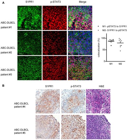 Figure 1. Coexpression of S1PR1 and phospho-STAT3 in ABC-DLBCL patient tumor cells. (A) Left panel: immunofluorescent staining of S1PR1 (green) and phospho-STAT3 (red) in ABC-DLBCL patient tumor tissue sections. Shown are 3 independent ABC-DLBCL patient tissue sections, representing 10 tested patient samples. Scale bar represents 50 μm. Right panel: quantification of 10 tested patient tissue sections for percentages of overlapping red (p-STAT3) and green (S1PR1) channels, shown as Manders colocalization coefficients M1 (p-STAT3 to S1PR1) and M2 (S1PR1 to p-STAT3), respectively. For each patient tumor section, 10 random fields were chosen to calculate M1 and M2, valued and normalized as mean, which is represented by a dot. One tumor tissue section from each of the 10 patients was analyzed. (B) Immunohistochemistry staining of S1PR1 and phospho-STAT3 of the same region, using consecutive ABC-DLBCL patient tissue sections. Scale bar represents 50 μm.