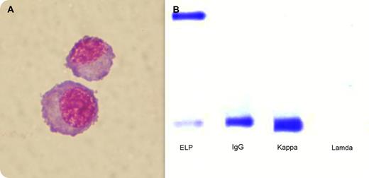 A 59-year-old woman in second remission of IgG, κ myeloma presented with confusion and nonlocalizing central neurologic and cerebellar signs. Magnetic resonance imaging showed meningeal enhancement. Lumbar puncture was atraumatic and revealed clear cerebrospinal fluid (CSF), an elevated protein content of 1.41g/L (normal < 0.45g/L), and a cell count of 0.1 × 109/L. The CSF cell differential revealed 76% plasma cells, 11% lymphocytes, 8% monocytes, 5% neutrophils, and no red cells. The plasma cells (panel A) were κ restricted. The CSF protein electrophoresis demonstrated IgG, κ chains (panel B). The albumin M-component ratio was ∼ 50% lower in CSF compared with serum. There were no plasma cells present in the peripheral blood smear. The presence of confusion, meningeal enhancement on MRI, and a clonal population of plasma cells in the CSF led to a diagnosis of meningeal myelomatosis. After a 28-day cycle of treatment with lenalidomide and dexamethasone, the confusion resolved and the plasma cells were no longer detectable in the CSF. Despite the remission of meningeal myelomatosis, she died with systemic myeloma 40 days later. / Mental confusion in myeloma is more commonly seen from renal failure, hypercalcaemia, infection, or hyperviscosity syndrome. In this patient's case, abnormal cognition was likely a consequence of meningeal myelomatosis. This is a rare complication of multiple myeloma and one with no well-defined treatment.
