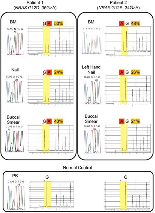 Figure 1. Direct sequencing and quantitative mutational analysis of NRAS in JMML patients. NRAS mutations are detected by direct sequencing and quantified by pyrosequencing. Direct sequencing identified oncogenic NRAS mutations: for Patient 1, G12D, 35G > A; for Patient 2, G12S, 34G > A) in BM-MNCs at diagnosis of JMML and in the nails and buccal smear cells. Quantification by pyrosequencing revealed that the fractions of mutated allele varied among different tissue types. For Patient 1: BM, 50%; nail, 24%; and buccal smear, 43%. For Patient 2: BM, 48%; left-hand nail, 26%; and buccal smear, 21%.
