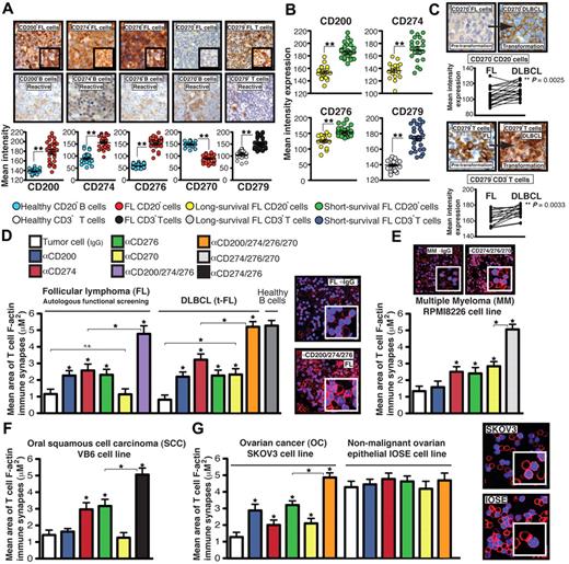 Figure 3. Tumor-induced T-cell actin synapse dysfunction mediated by inhibitory ligands is a common immunosuppressive mechanism used by hematologic and solid carcinoma cells. (A) IHC mean intensity expression ± SEM of CD200, CD274, CD276, and CD270 on intrafollicular CD20+ cells and CD279 expression on interfollicular CD3+ T cells in lymph tissue from FL patient samples compared with reactive lymph node samples (representative high-power 40× magnification and 63× inset images are shown). (B) Mean expression analysis ± SEM using an extremes of survival diagnostic FL TMA (>15-year long survival group compared with < 5-year short-survival patient group). (C) Representative high-power 40× magnification of CD270 expression on CD20+ tumor cells and CD279 expression on CD3+ T cells in TMA cores from pretransformation (FL) biopsy compared with each patient's transformation (DLBCL) biopsy. Comparison of expression between FL and transformation to DLBCL. (D) Autologous patient peripheral blood T-cell or healthy donor allogeneic T-cell F-actin synapse function with third-party healthy donor allogeneic B cells (+sAg) as APCs after primary coculture (24 hours) with primary tumor-infiltrated FL cells or DLBCLs (D), MM cell line RPMI8226 (E), SCC cell line VB6 (F), OC cell line SKOV3 (G) or a nonmalignant human ovarian epithelial cell line IOSE pretreated with neutralizing Abs (α). Colored columns show the mean T-cell synapse area ± SD from 6 donor functional screens. The confocal images show T-cell/APC conjugates after primary coculture with treated tumor cells (minimum n = 100 analyzed per experiment). Original magnification, 63×. *P < .05; **P < .01.