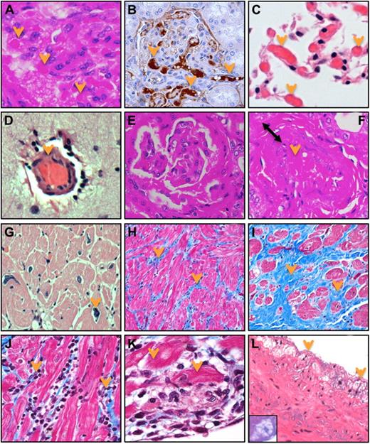 Figure 3. Diverse spectrum of cardiovascular lesions in pathogenic SIVagm infection of PTMs. Thrombotic microangiopathy (TMA) characterized by numerous thrombi in capillaries and small arteries was detected in multiple organs. (A) Kidney (H&E staining). (B) Immunohistochemistry for fibrinogen (brown). (C) Lung (H&E staining). (D) Brain (H&E staining). (E) Glomerulopathy characterized by either focal and segmental glomerulosclerosis or collapse and fibrosis of the entire glomerular tuft was observed in SIVagm-infected PTMs (H&E staining). (F) Arteritis, characterized by significantly thickened wall (double arrow) and lumen occlusion (arrow) was detected in the kidney (H&E staining). (G) Heart hypertrophy characterized by enlarged myocytes with irregular nuclei (arrow) was observed (H&E staiing). (H) Fibrosis of the heart characterized by increased diffuse deposition of collagen replacing drop-out or lysed myocytes (blue), or (I) focal large area of fibrosis replacing areas of infarction was detected using Gomori 1-step trichrome staining (nuclei-black, muscle-red, collagen-blue). (J) Myocarditis characterized by severe infiltration with mononuclear cells (arrows; Gomori staining) and (K) extensive myocyte cytolysis (arrows; Gomori staining) was also diagnosed. (L) Incipient lesion of atherosclerosis (fatty streaks) were found in the aorta of SIVagm-infectd PTMs, characterized by accumulation of foamy macrophages (inset) in the tunica intima, under the aortic endothelium (H&E staining). Slides were visualized with a Carl Zeiss Axio Imager M1 microscope using the following objectives: 10×/0.3 DICI Plan Neofluar, 20×/0.8 DICII Plan Apochromat, and 40×/0.75 DICII Plan Neofluar. Micrographs were taken with a Carl Zeiss AxioCam MRc5. Images were acquired and analyzed using Carl Zeiss Axio Vision SE64 Release 4.8.2. The original magnification of all the pictures was 400×. Images were cropped with Adobe Photoshop CS6.