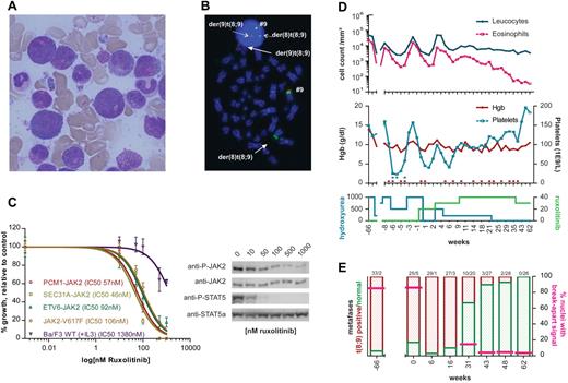 Figure 1. Ruxolitinib inhibits PCM1-JAK2 in vitro and in vivo. (A) Bone marrow smear at diagnosis, showing hypereosinophilia and marked hypergranularity of neutrophils and their precursors. (B) FISH on a cytogenetic marrow specimen at diagnosis. Dual color JAK2 break-apart FISH was performed using the following probes: RP11 307I14–RP11 125K10–RP11 509D8 (Spectrum Green) and RP11 140C18–RP11 635N21 (Spectrum Orange), as described.5 The t(8;9) leads to translocation of the green signal to der(8), while the red probes and a tiny little green signal are retained on the der(9) (solid arrows). The same break-apart pattern is observed in interphase cells (dotted arrows). (C) Dose-response curves of Ba/F3 cells expressing PCM1-JAK2, ETV6-JAK2, SEC31A-JAK2, or JAK2-V617F (left panel). Cells were treated for 24 hours with various concentrations of ruxolitinib, diluted in DMSO immediately before use. The proliferation relative to untreated controls is shown. The growth of wild type Ba/F3 in the presence of IL-3, and various concentrations of ruxolitinib is also shown (curves fitted with GraphPad Prism 5). Western blot analysis of 2 × 106 PCM1-JAK2–transformed Ba/F3 cells after treatment with ruxolitinib for 90 minutes (right panel). Gel electrophoresis was performed using NuPage Bis-Tris 4%-12% gels (Invitrogen). Immunoblotting was done with anti-phospho-JAK2, anti-JAK2, anti-phospho-STAT5, anti-STAT5a (Cell Signaling Technology), and anti–mouse/anti–rabbit peroxidase-labeled antibodies (Amersham Biosciences). (D) Evolution of peripheral blood counts before and after initiation of ruxolitinib. The top panel depicts the evolution of peripheral leukocyte count (blue) and absolute eosinophil count (pink) over time. The middle panel shows hemoglobin levels (red) and platelet count (blue) over time. Erythrocyte or platelet transfusions are shown as red and blue dots above the x-axis. The average daily dose (mg) of hydroxyurea and ruxolitinib are shown in the bottom panel. Start of ruxolitinib treatment is time point 0. (E) Evolution of bone marrow karyotype and FISH. Bars show the relative proportion of t(8;9)-positive metaphases (red) versus normal metaphases (green). The number of t(8;9)-positive metaphases versus normal metaphases is indicated above each bar. Pink lines indicate the percentage of interphase nuclei with a break-apart pattern in these marrow specimens.