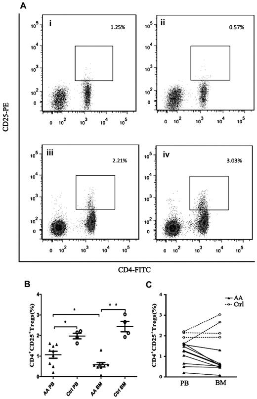 Figure 1. Decreased frequencies of Tregs in PB and BM from patients with AA. (A) Representative flow cytometric analysis of Tregs frequencies (gated on lymphocyte population) in (i) AA PB, (ii) AA BM, (iii) control PB, and (iv) control BM. (B) Frequencies of CD4+CD25+ Tregs in PB and BM of AA patients (n = 9) and healthy controls (n = 4). (C) Reversed ratio of frequencies of CD4+CD25+ Tregs between BM and PB in AA. Data were expressed as mean ± SEM. *P < .05; **P < .001.