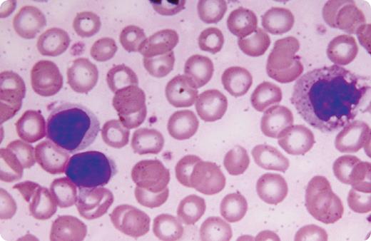 A 50-year-old female with low-grade chronic anemia and no other medical problems was evaluated when her hemoglobin fell to 8.2 g/dL. She had no adenopathy or hepatosplenomegaly. Her white cell count was 7.7 × 109/L with a lymphocyte count of 6.2 × 109/L, platelets 498 × 109/L, and reticulocyte count that was normal. Serum electrophoresis and rheumatoid factor were negative and ANA was weakly positive. Peripheral blood smear showed normocytic normochromic red cells and atypical large granular lymphocytes (see figure). Bone marrow examination showed prominence of lymphoid cells, most of which were granular. Aggregates of lymphocytes were noted that comprised approximately one-third of the nucleated cells. Special tests affirmed that these cells were of T-cell origin. A diagnosis of T-cell large granular lymphocyte leukemia was made. She was placed on chronic steroids because of the indolent nature of the disease. Two years later oral weekly methotrexate was added because of symptomatic progression manifested by worsening anemia (hemoglobin 6.3 g/dL). Subsequently, she died of complications after an episode of acute cholecystitis. / T-cell large granular lymphocyte leukemia is a chronic disorder often treated by observation only. When evidence of progression occurs, immunosuppressive medications are usually tried. The disease can also be associated with other immunologic disorders.