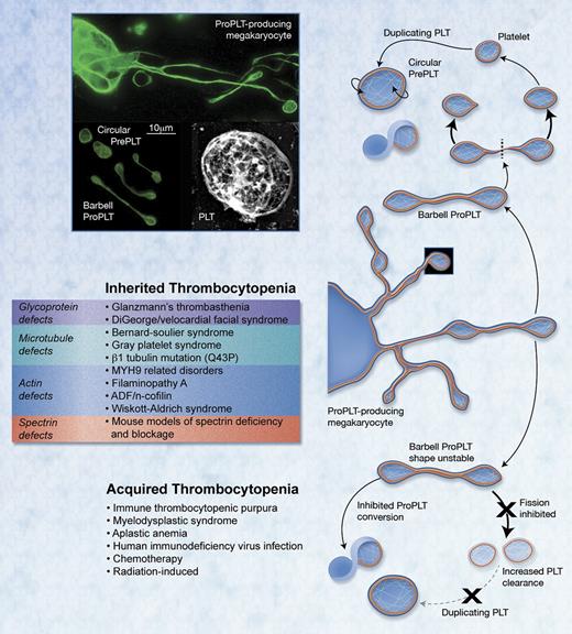 Figure 1. Cytoskeletal model of PLT production. Top left: immunofluorescence microscopy images of a proPLT producing MK, released barbell-proPLTs, and circular-prePLTs from a mouse fetal liver cell culture probed for β1-tubulin; rapid-freeze electron microscopy image of the PLT cytoskeleton. Bottom left: list of inherited thrombocytopenias affecting platelet size, grouped by underlying defect; list of common causes of acquired thrombocytopenia. Top right: model of the terminal stages of PLT production. Released proPLTs undergo successive rounds of fission along their midbody and at their ends to generate circular prePLTs and barbell-proPLTs. Circular prePLTs reversibly convert into barbell-proPLTs, from which PLTs are released after a final fission event at their midsection. PLTs may enlarge during culture and contribute to further PLT production. Bottom right: model of suspected errors in terminal PLT production that can account for phenotypes expressed in common inherited and acquired thrombocytopenias. For immunofluorescence microscopy, samples were fixed with 4% formaldehyde for 15 minutes and then permeabilized with 0.5% Triton X-100 and blocked in immunofluorescene blocking buffer (1% BSA, 0.05% sodium azide, and 10% FCS in PBS) overnight before antibody labeling. To demarcate permeabilized cells, samples were incubated with a rabbit polyclonal primary antibody for mouse tubulin generated against the C-terminal peptide sequence LEDSEEDAEEAEVEAEDKDH (Genemed Synthesis). Samples were treated with a secondary goat anti–rabbit antibody conjugated to an Alexa Fluor 488 (Invitrogen). Samples were examined with an Axiovert 200 microscope (Carl Zeiss) equipped with a 63× (numeric aperture, 1.4) PlanApoChromat oil immersion objective, and images were obtained using a charged coupled device camera (Hamamatsu). Images were analyzed using Metamorph image analysis Version 7.7.2.0 software (Molecular Devices) and ImageJ Version 1.45r software. Professional illustration by Alice Y. Chen.